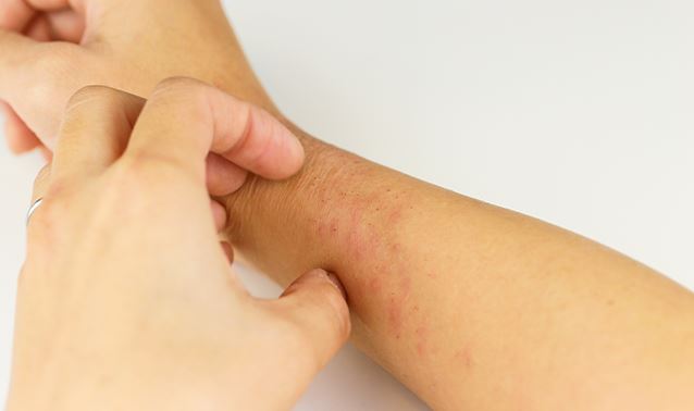 Penyebab Kulit Gatal